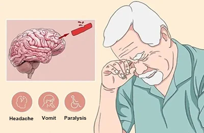 idebenone improves cerebrovascular disease idebenone improves cerebrovascular disease